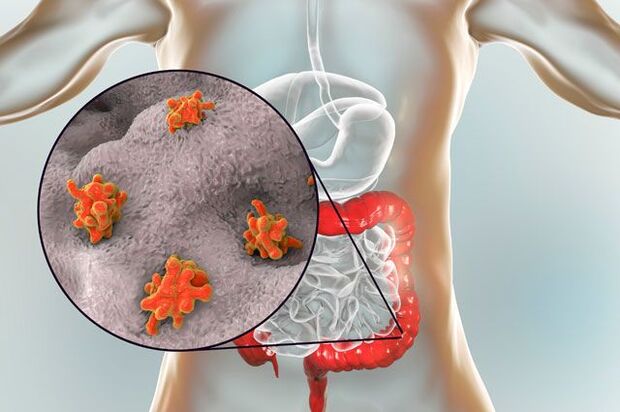 types de parasites dans le corps humain
